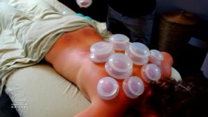 Cupping Massage: Therapeutic Interventions